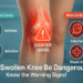 Can a Swollen Knee Be Dangerous